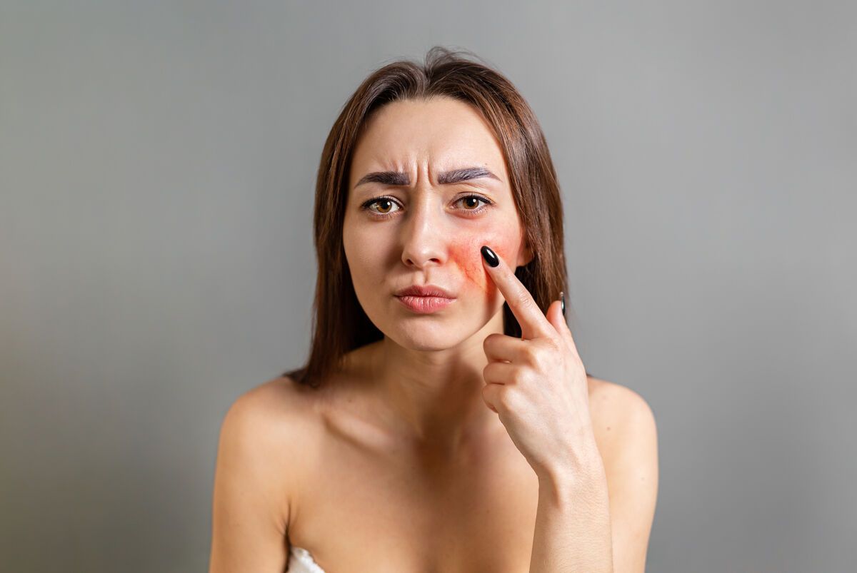 Natural remedies for rosacea