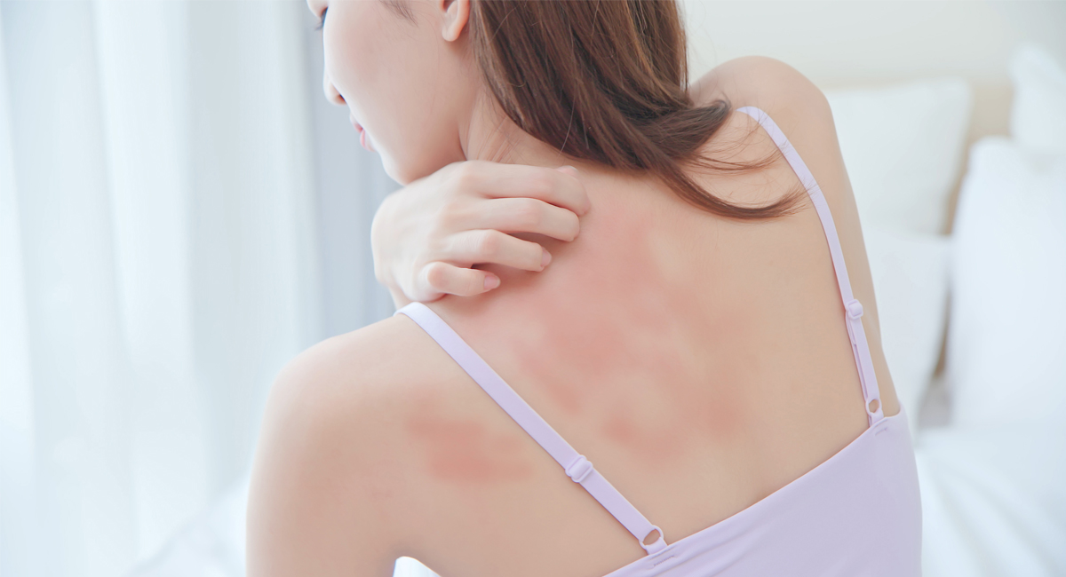Eczema cases increase fourfold after Covid
